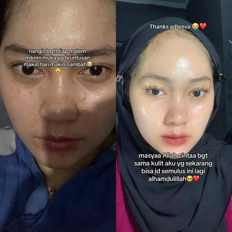 ADLEEVA Paket Hemat Acne Bright Series "COMPLETE" (Paket Isi 5 - Free Acne Blemish Spot)