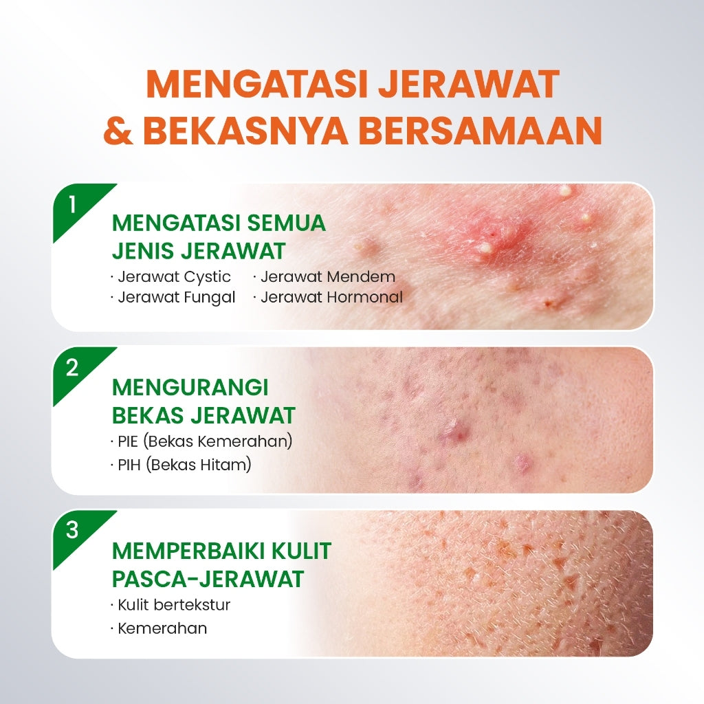 [NEW UPGRADED] YOU AcnePlus Spot Care Pro Serum Obat Totol Jerawat Obat Jerawat Obat Bekas Jerawat