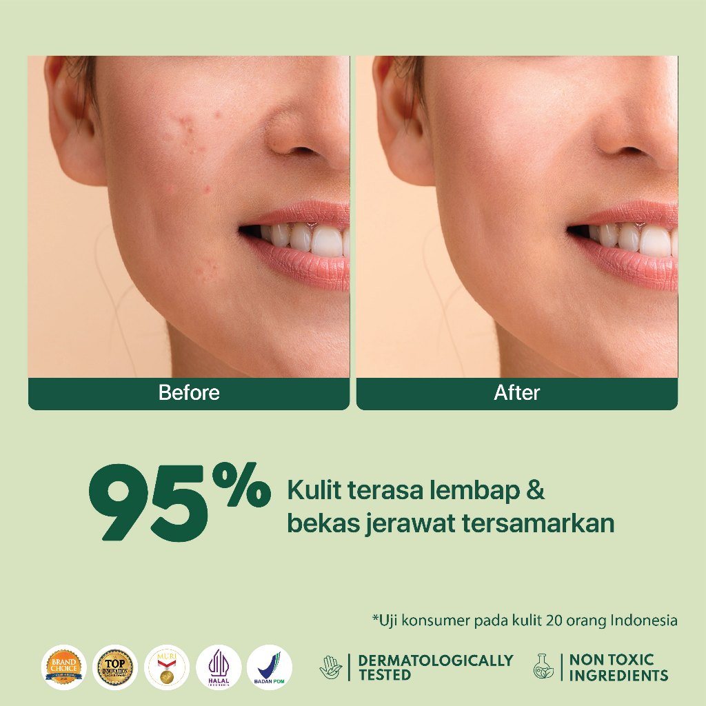 BUNDLING NPURE Acne Face Toner Centella Asiatica 150ml + Acne Clear Barrier Moisturizer Wajah Berjerawat