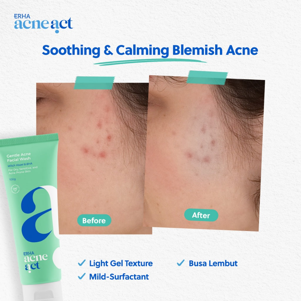 ERHA Acneact Low Ph Gentle Facial Wash 100g - Sabun Wajah Jerawat Kulit Sensitif  Ph Balance Low ph