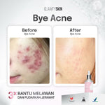Glawfyskin Serum Bye Acne | Serum Jerawat By Glawfyskin BPOM