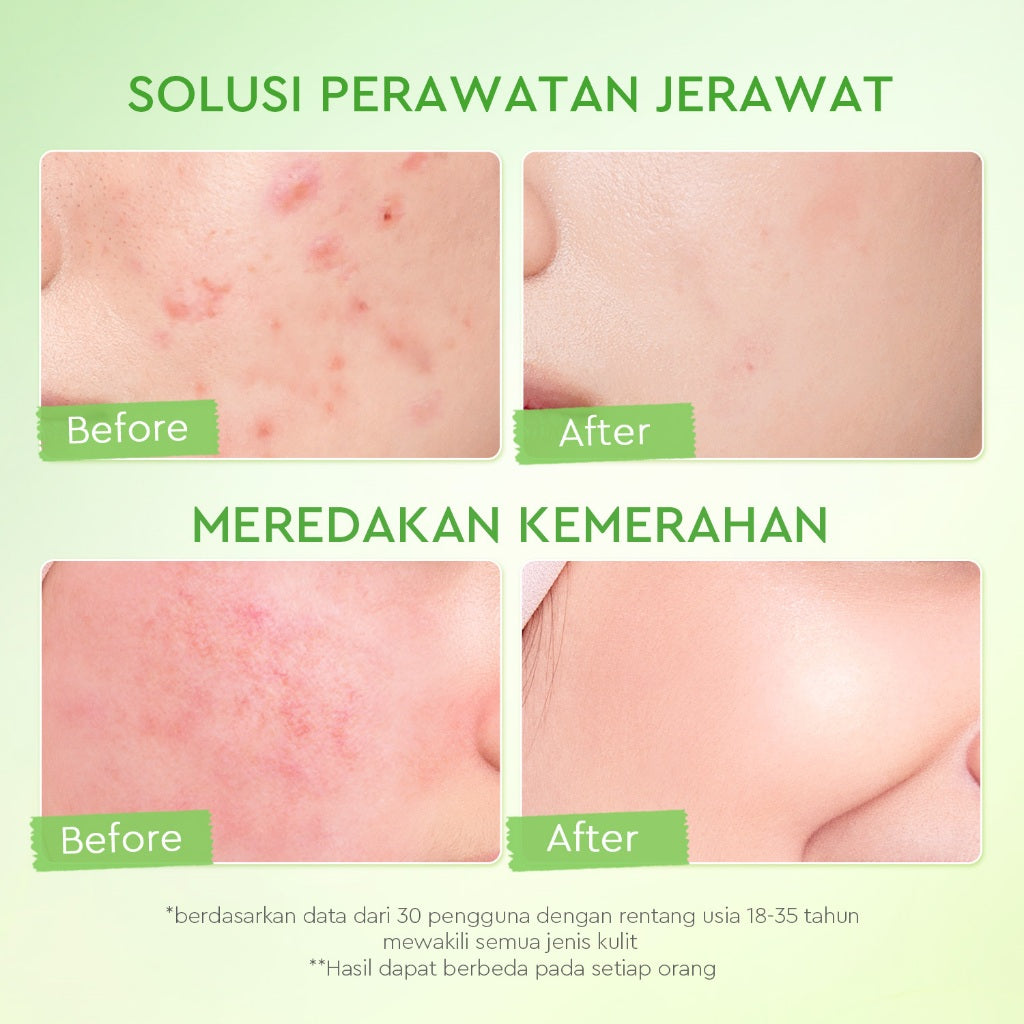 [BIG MOIST] GLAD2GLOW Kiwi 3D Acid Acne Moisturizer 100g Pelembab Wajah Jerawat Mencerahkan Pencerah Wajah&Penuaan Hilangkan Flek & Tenangkan Kulit Skincare Pelembab Esensi Wajah Perawatan Kulit Pelembab Wajah Pembersih day cream tone up g2g officialstore