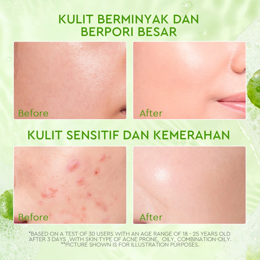 Glad2Glow Acne Jerawat Bundle 4pcs paket Centella madeca cream-Moisturizer+Serum+Cleanser+Toner Skincare Centella Masker Menghilangkan Menenangkan kemerahan pada kulit Atur Minyak BerlebihMerawat Kulit g2glow official store acnaway