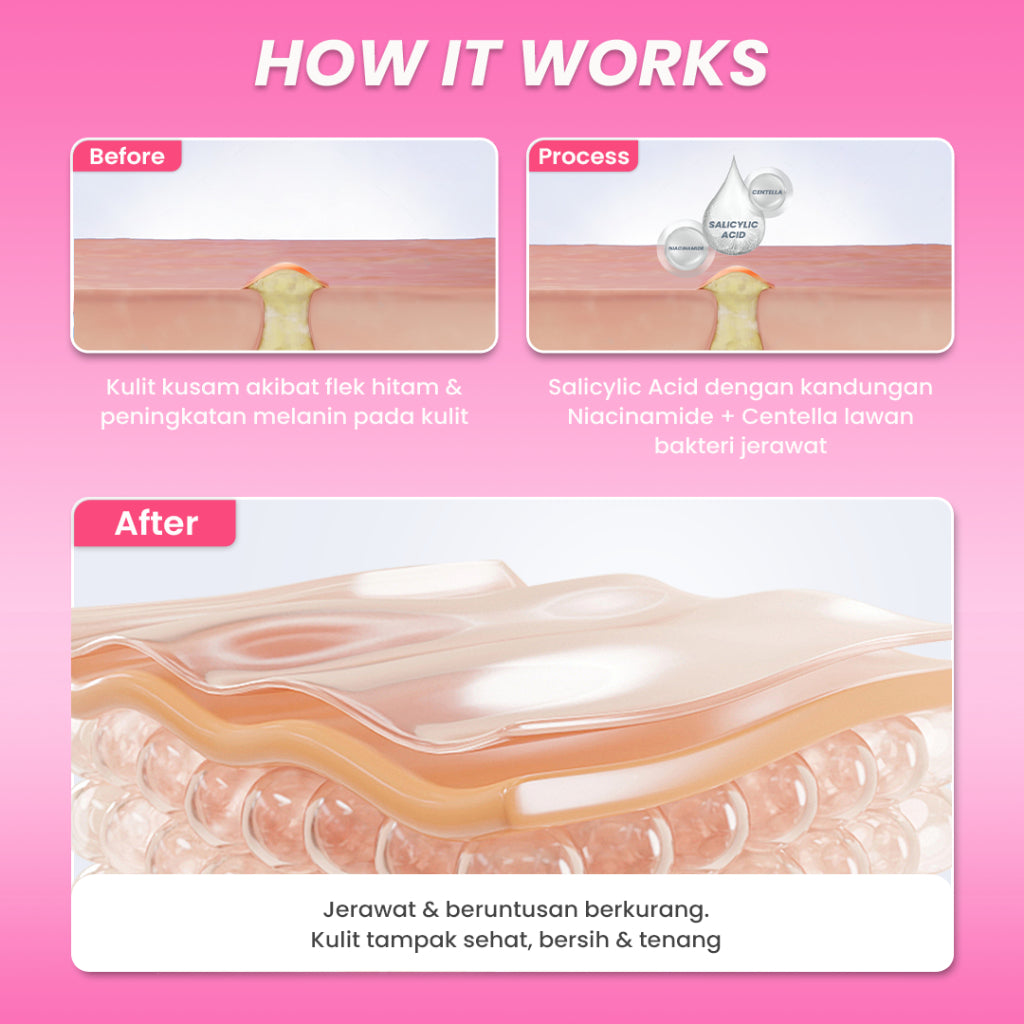 Hanasui Anti Acne Serum - Jerawat & Beruntusan Menenangkan dengan Centella Asiatica Salicylic Acid & Niacinamide