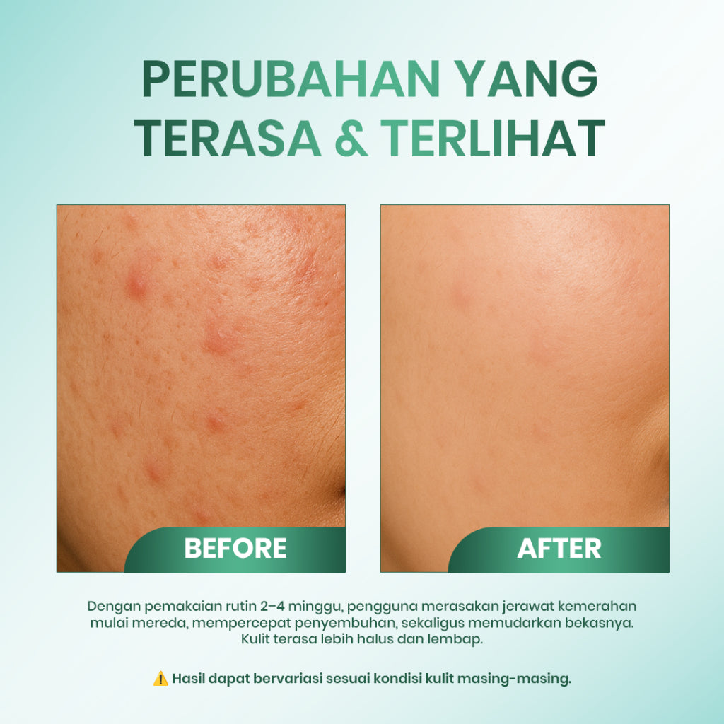 Cleora Acne Soothe Spot Gel - Obat Totol Jerawat Membantu Menyembuhkan Mengempeskan Jerawat Menyamarkan & Mencerahkan Noda Hitam Cream Salep Perawatan Menenangkan Kemerahan Acne Wanita Pria