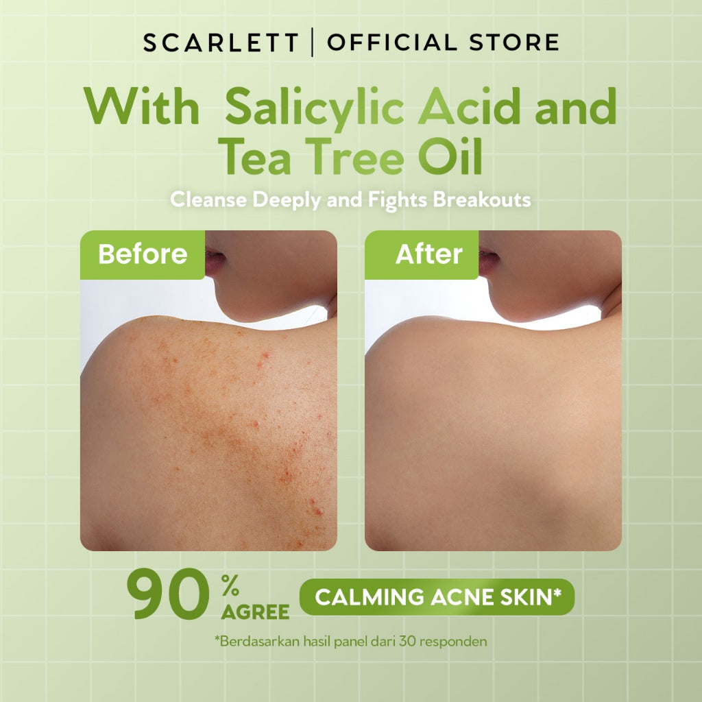 SCARLETT Perfumed Shower Serum 400ml – Acne Care | Anti-Acne Shower Gel dengan Salicylic Acid & Tea Tree Oil | Sabun Mandi Cair untuk Jerawat Punggung & Dada, Membersihkan Pori, Menenangkan Kulit Berjerawat | Shower Serum dengan Wangi Parfum Mewah
