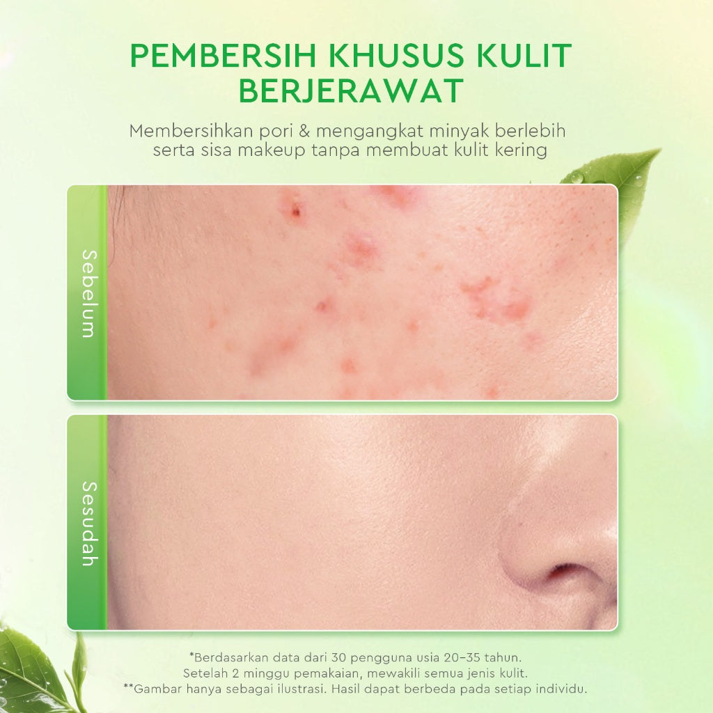 [New]Glad2Glow Matcha Salicylic Acid Acne Facial Cleanser 80ml Anti Jerawat Kontrol Minyak Face Wash Oily Acne Prone Skin Friendly sabun cuci muka g2g