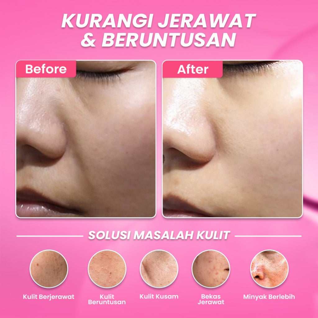 Hanasui Anti Acne Serum - Jerawat & Beruntusan Menenangkan dengan Centella Asiatica Salicylic Acid & Niacinamide
