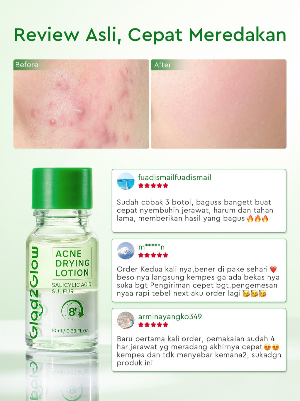 GLAD2GLOW Acne Drying Lotion Mengeringkan Jerawat 8 Jam Dengan Sulfur BHA & Bahan Alami Instant Acne Care Acne Gel Patch Spot Jerawat Serum Moisturizer Acne Skincare Wajah face wash facial Salicylic Acid Niacinamide g2glow official store