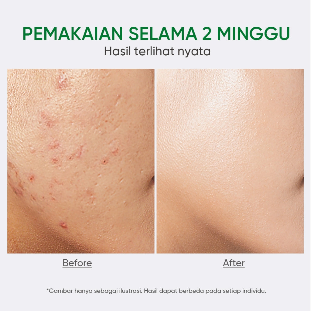 FACERINNA 2% Salicylic Acid + 2% Niacinamide Acne Serum 20ml |  Serum Jerawat Acne Treatment Menghilangkan Bekas Jerawat Kulit Beruntusan Mencegah Jerawat Datang Lagi Calms Acnes&Redness Prevents Breakout | Anti-Acne Exfoliating Brightening Pemutih Wajah