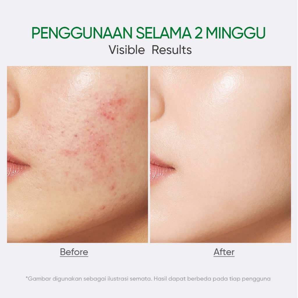 FACERINNA Salicylic Acid Acne Moisturizer | Pelembab Wajah Anti Jerawat Melawan & Mencegah Jerawat Meredakan Peradangan Membuka Pori Mengontrol Minyak Menghaluskan Tekstur Kulit Melembapkan Cepat Menyerap Skincare BPOM with Niacinamide Kulit Berminyak