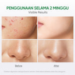 FACERINNA Salicylic Acid Acne Toner 100 ml | Centella Acne Calming Toner Wajah Pore Refining Oil Control Anti-Acne | Acne Jerawat untuk Mengontrol Minyak & Meredakan Kemerahan Acne Treatment Gentle Exfoliating Exfoliasi Wajah Clarify & Refine Pores