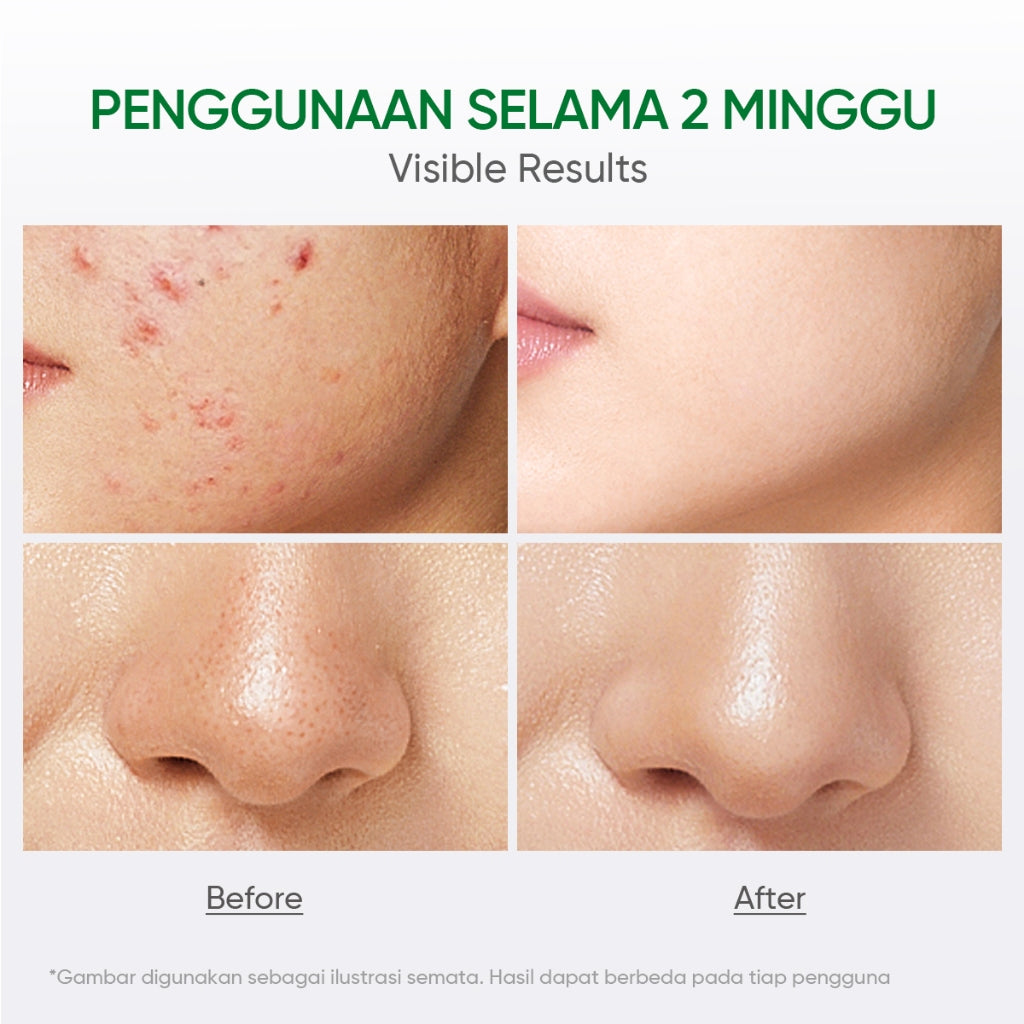 FACERINNA Salicylic Acid Acne Toner 100 ml | Centella Acne Calming Toner Wajah Pore Refining Oil Control Anti-Acne | Acne Jerawat untuk Mengontrol Minyak & Meredakan Kemerahan Acne Treatment Gentle Exfoliating Exfoliasi Wajah Clarify & Refine Pores
