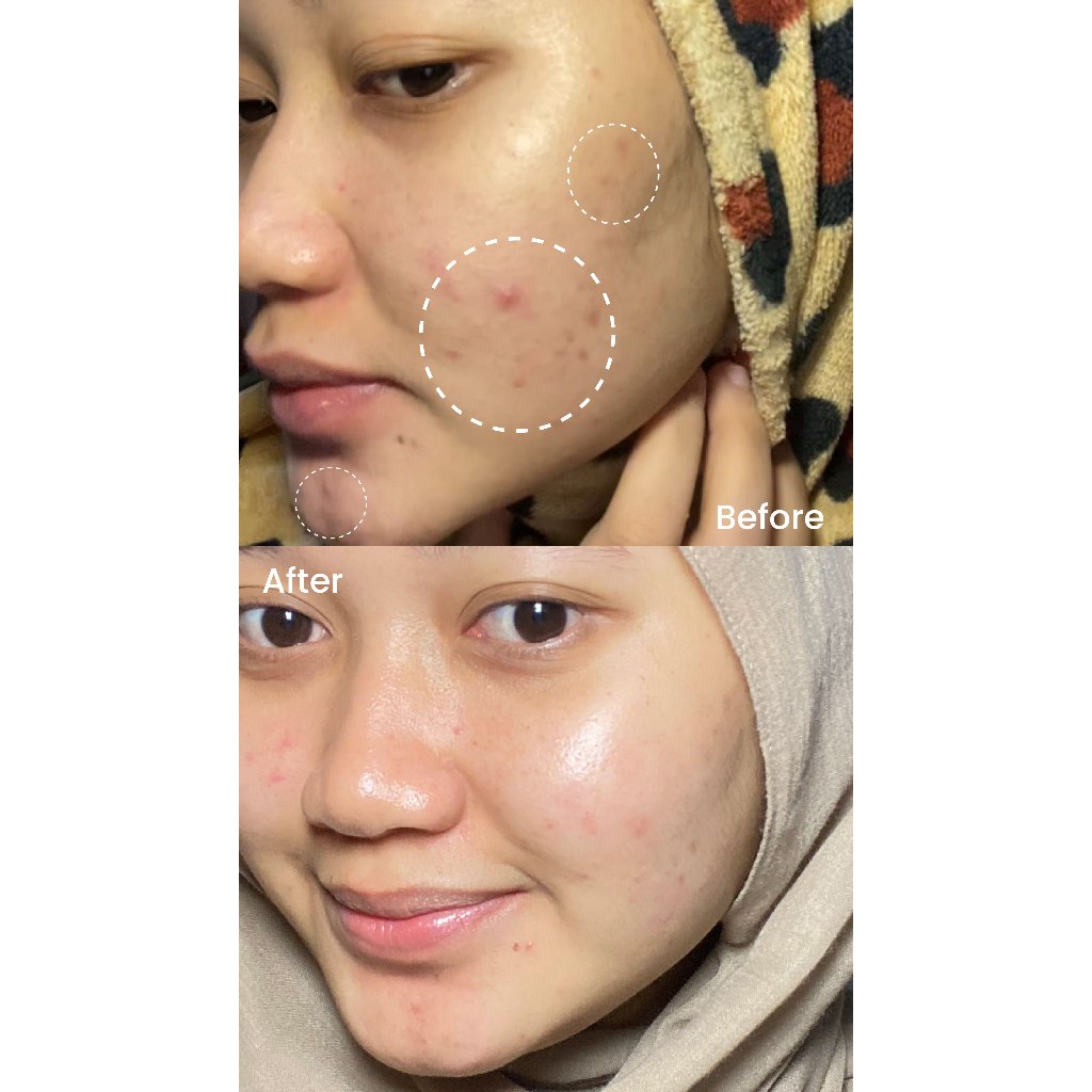 Ultimate Glow Hydration Set I Bundling Peeling Serum + Moisturizer Barrier I Combo Glowing