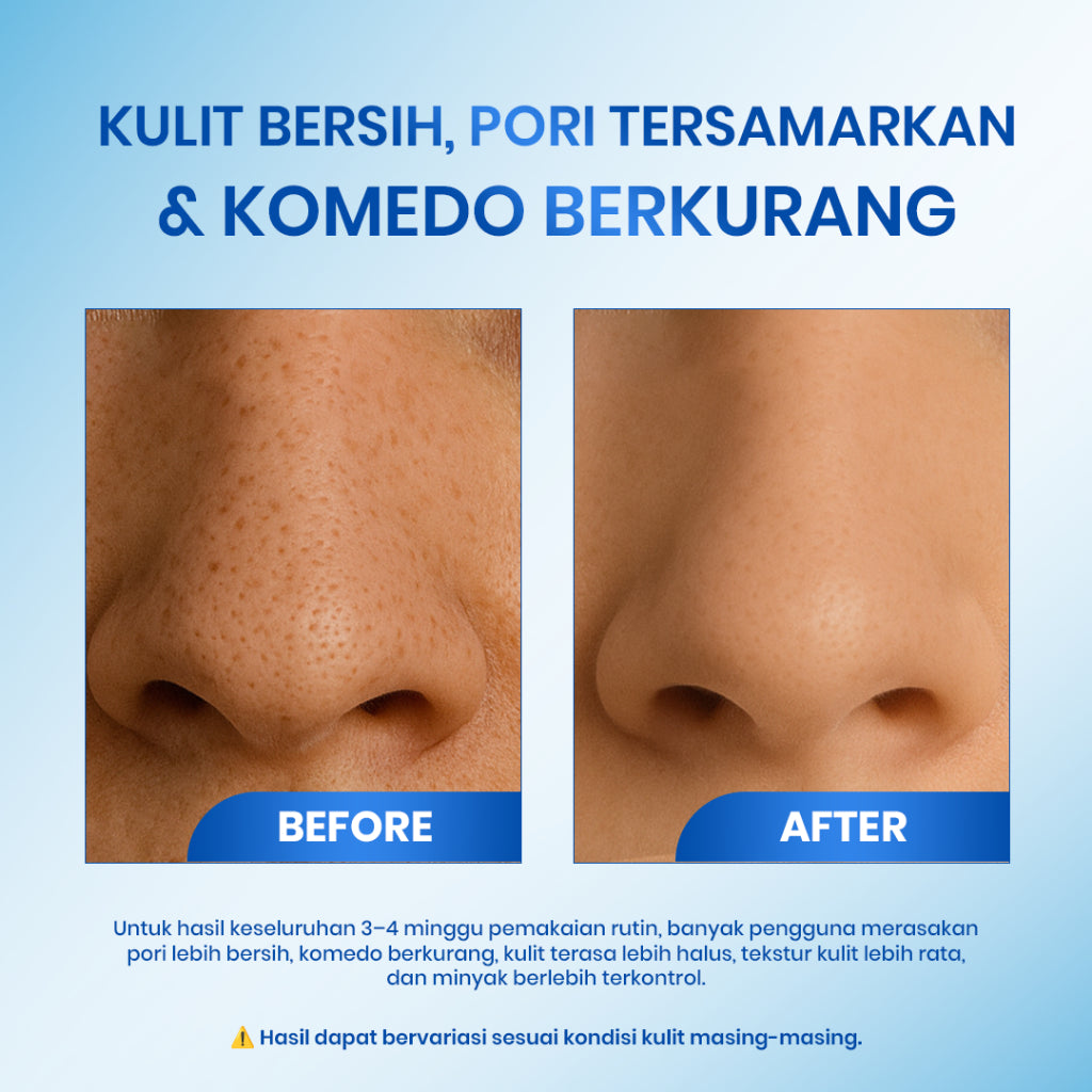 [ORDER NOW!HEMAT 75RB] Cleora Whitening Set - Skincare Pore Glow Exfoliasi Toner & Calendula Body Lotion Wajah Wanita Pria Mengangkat Sel Kulit Mati Eksfoliasi Muka Brightening Mencerahkan Komedo Jerawat Acne Handbody Niacinamide Body Butter Cream Pemutih