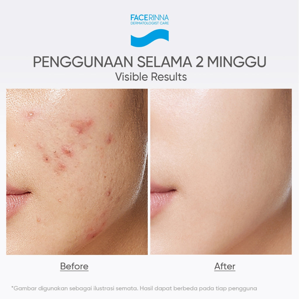 FACERINNA Salicylic Acid Acne Gel Cleanser 70ml / 120ml  | Gentle Sabun Cuci Muka Menenangkan Jerawat Mengontrol Minyak & Menghilangkan Komedo Oil Control Clean Calming Down Facial Wash Skincare Face Wash Cleansing Balm Pembersih Wajah  | Panthenol Gentl