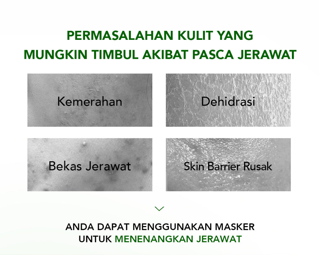 [NEW] YOU AcnePlus B5 Soothing Sheetmask Masker Jerawat dan Hydrating Bebas Jerawat