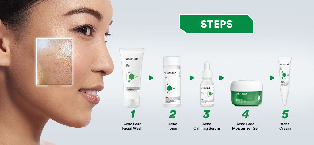 Whitelab 5 pcs Paket Acne Lengkap - Facial Wash, Toner, Serum, Moisturizer, Acne Cream Paket Skincare