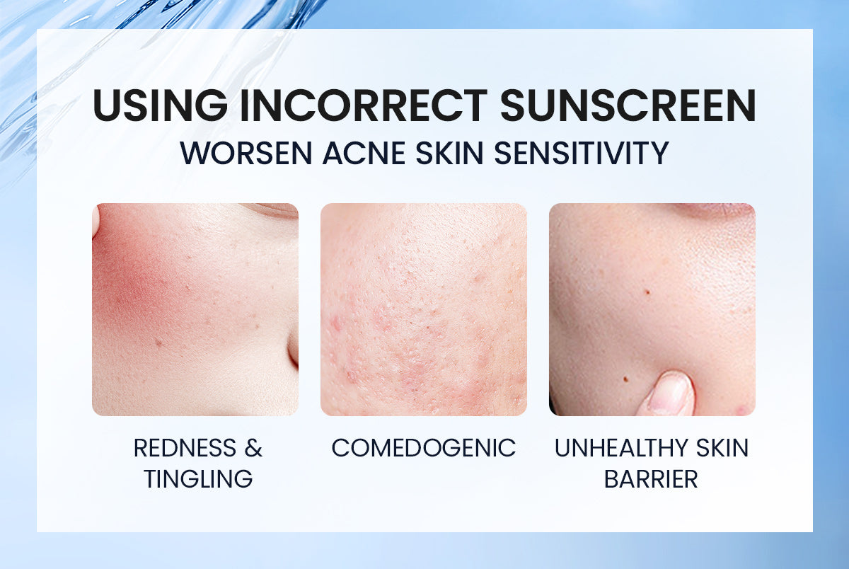 YOU Sunbrella Intensive Care Watery Sunscreen SPF50+ PA++++ Tabir Surya Kulit Sensitif 8X Protection Sensitive Acne Skin Friendly