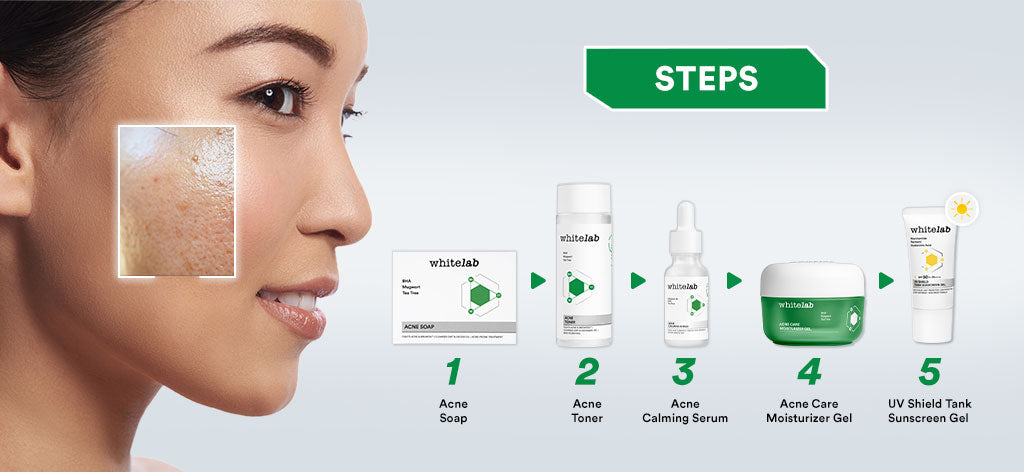 Whitelab 4 pcs Paket Acne - Facial Wash, Toner, Serum, Moisturizer Paket Skincare