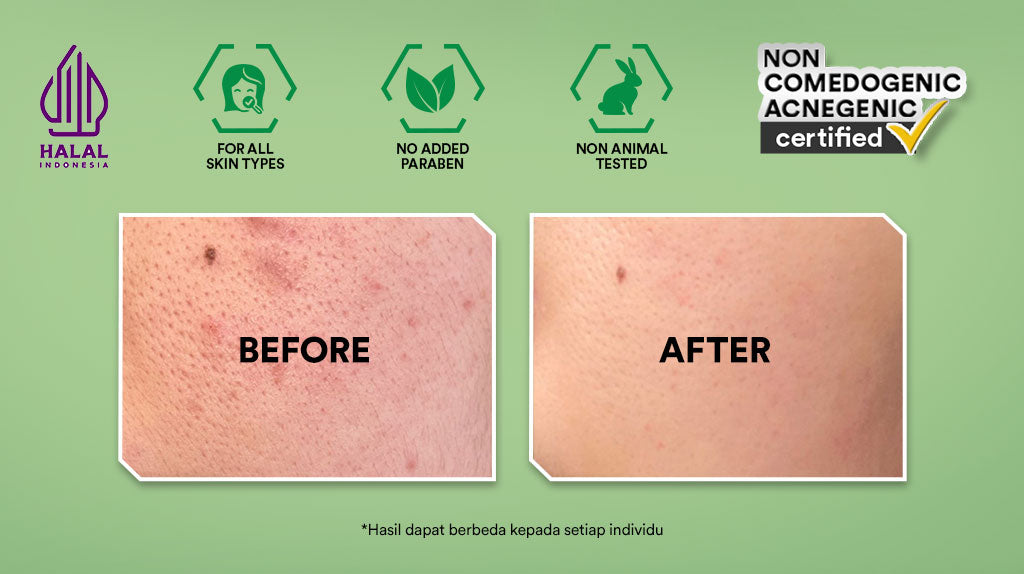 Whitelab Acne Care Moisturizer Gel - Pelembap Kulit Wajah untuk Mengurangi dan Meredakan Jerawat Pagi Malam dengan BHA, Mugwort & Tea Tree [BPOM]