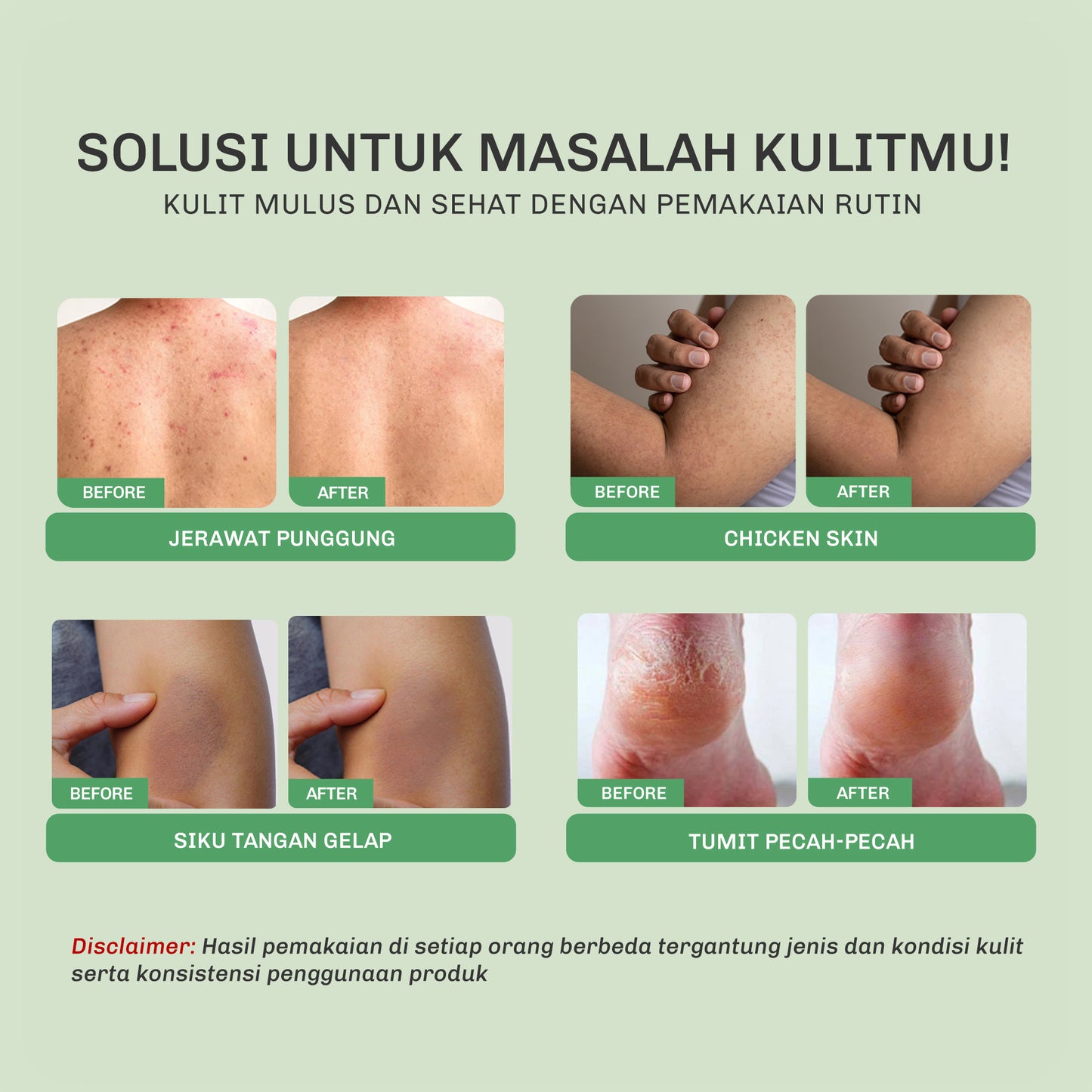 Lavojoy Solve It Now Body Serum | Body Lotion Untuk Melembabkan Kulit Sensitif,  Merawat Kulit Berjerawat, Menghaluskan Tekstur Kulit Kasar Dan Anti Jerawat | Mengandung Amino Acid, AHA, BHA Dan Zinc PCA