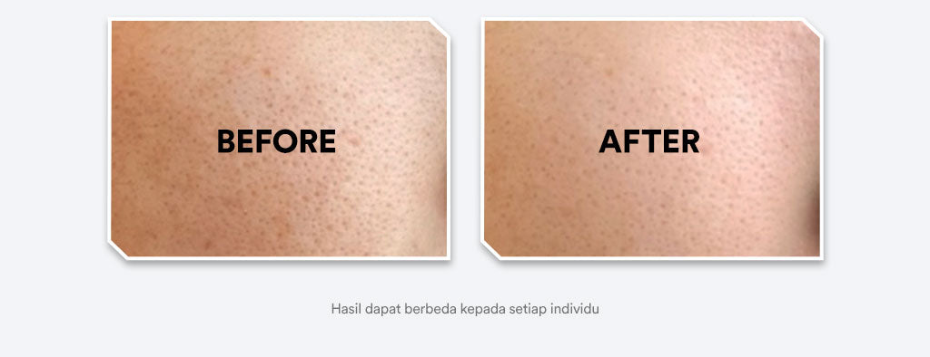 Whitelab Mugwort Pore Clarifying Mask - Masker Pori Pori Kecil Minimalis Bebas Jerawat dengan Mugwort BHA Tea Tree [BPOM]