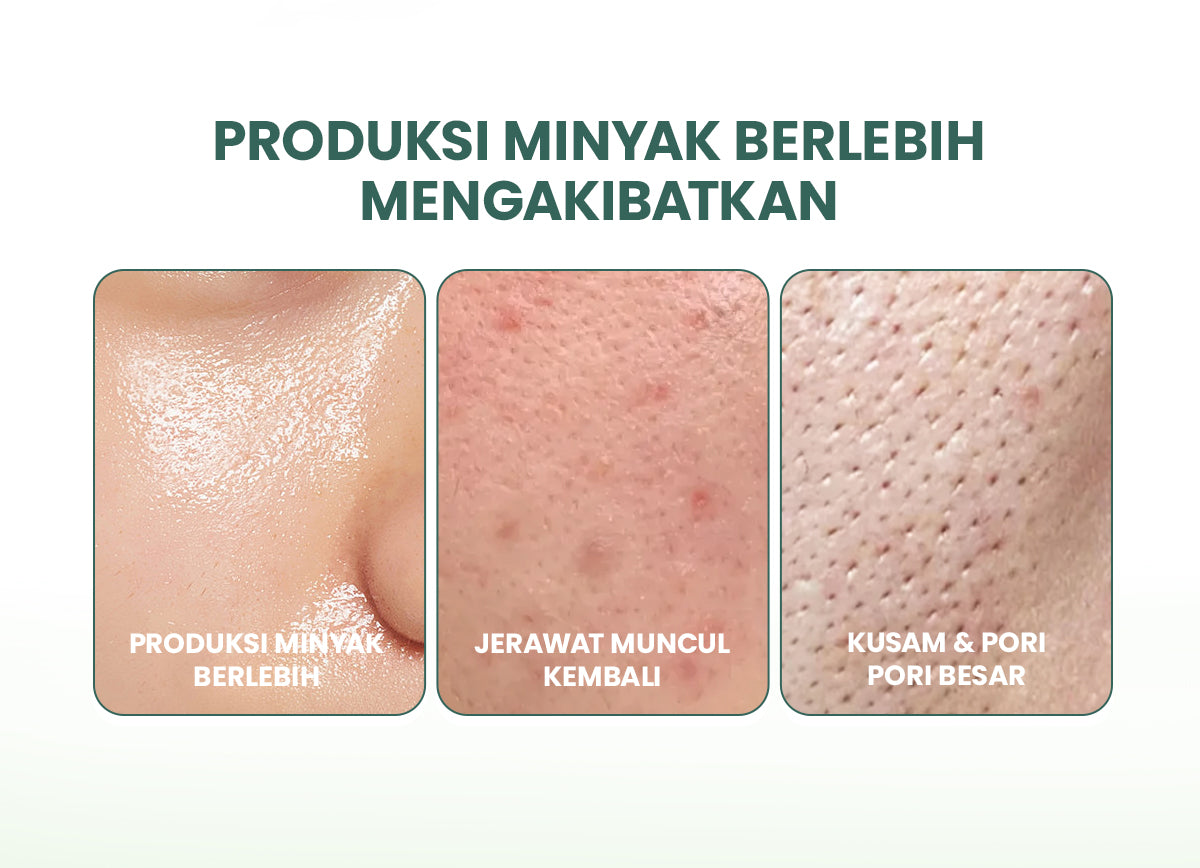 YOU AcnePlus AHA BHA PHA Daily Essence Toner Kulit Berminyak Jerawat Centella dan Oil Control