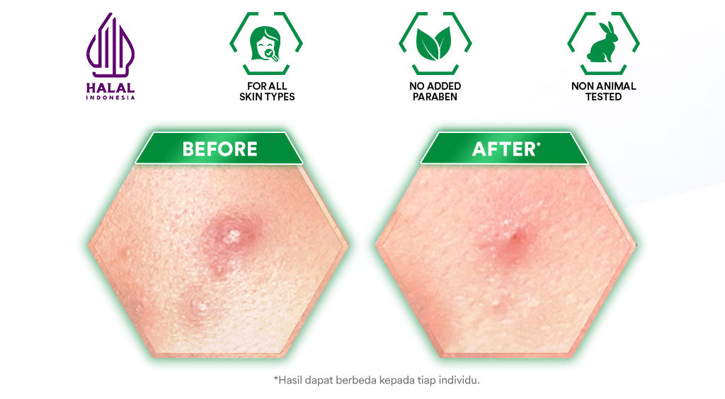 Whitelab Acne Cream - Krim Totol Atasi Jerawat dalam 2 Hari dengan Sulfur, Calamine & Mugwort [BPOM]