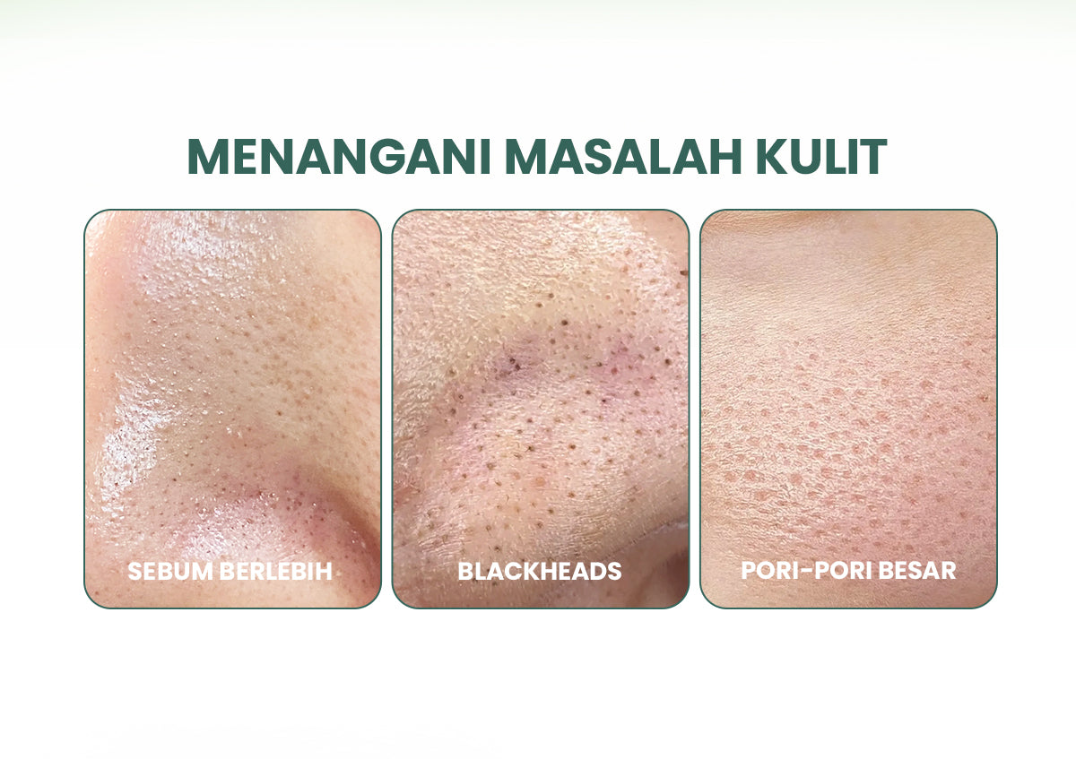 YOU AcnePlus 5X Acids Exfoliating Pads Pads Anti Jerawat Eksfoliasi Kulit Berminyak Bebas Jerawat 30 pads