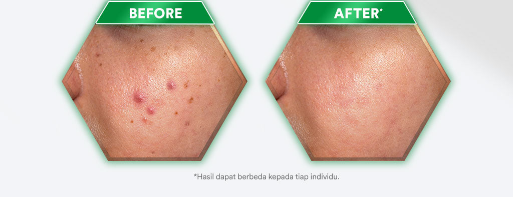 Whitelab Acne Calming Serum - Serum untuk Kulit Jerawat, Bruntusan, dan Berminyak dengan Mugwort, BHA & Tea Tree [BPOM]