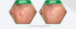 Whitelab Acne Calming Serum - Serum untuk Kulit Jerawat, Bruntusan, dan Berminyak dengan Mugwort, BHA & Tea Tree [BPOM]