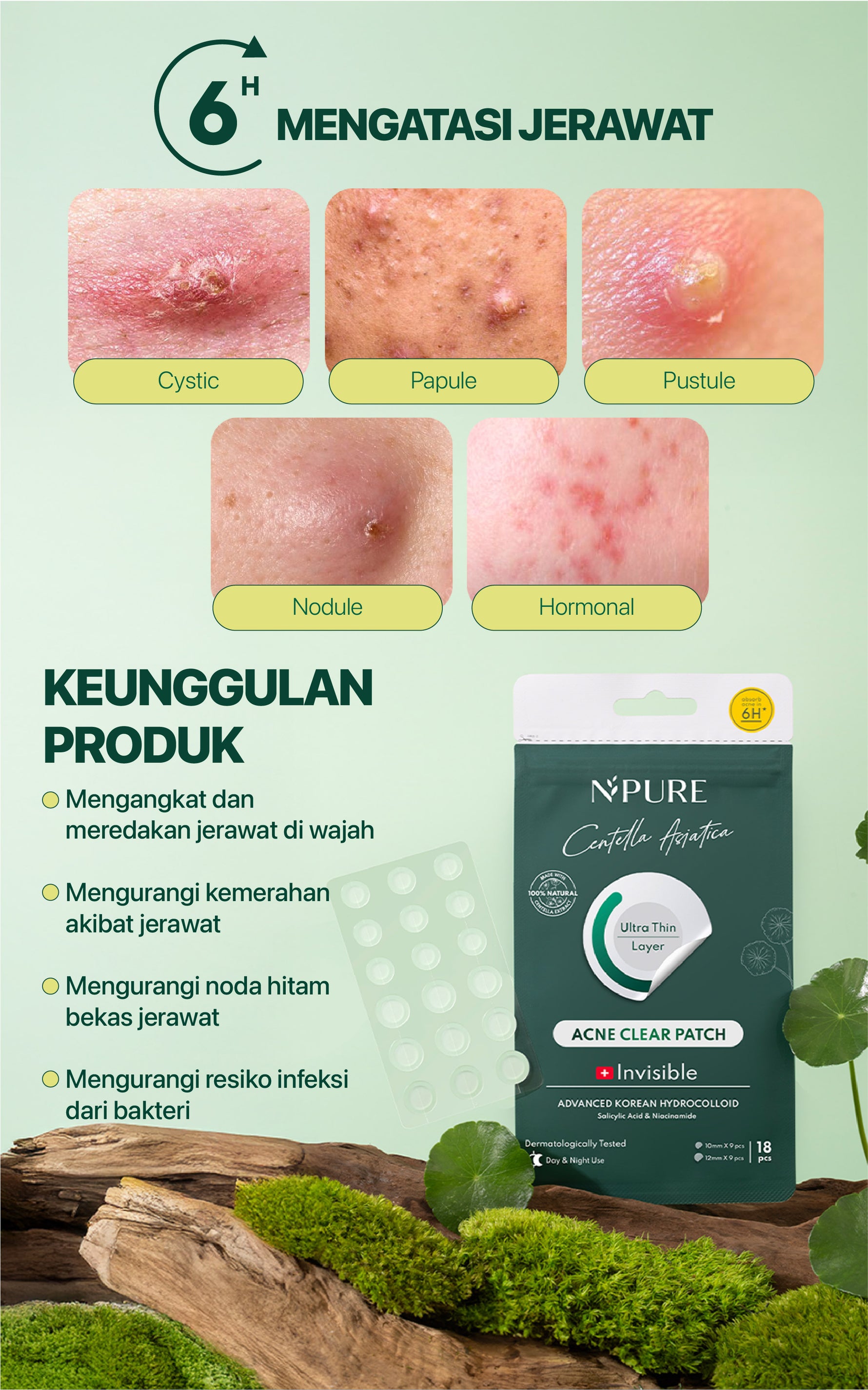 NOT FOR SALE - NPURE Acne Clear Patch isi 18Pcs / Ultra thin layer / Patch Jerawat / Acne Skin / Untuk kulit Berjerawat