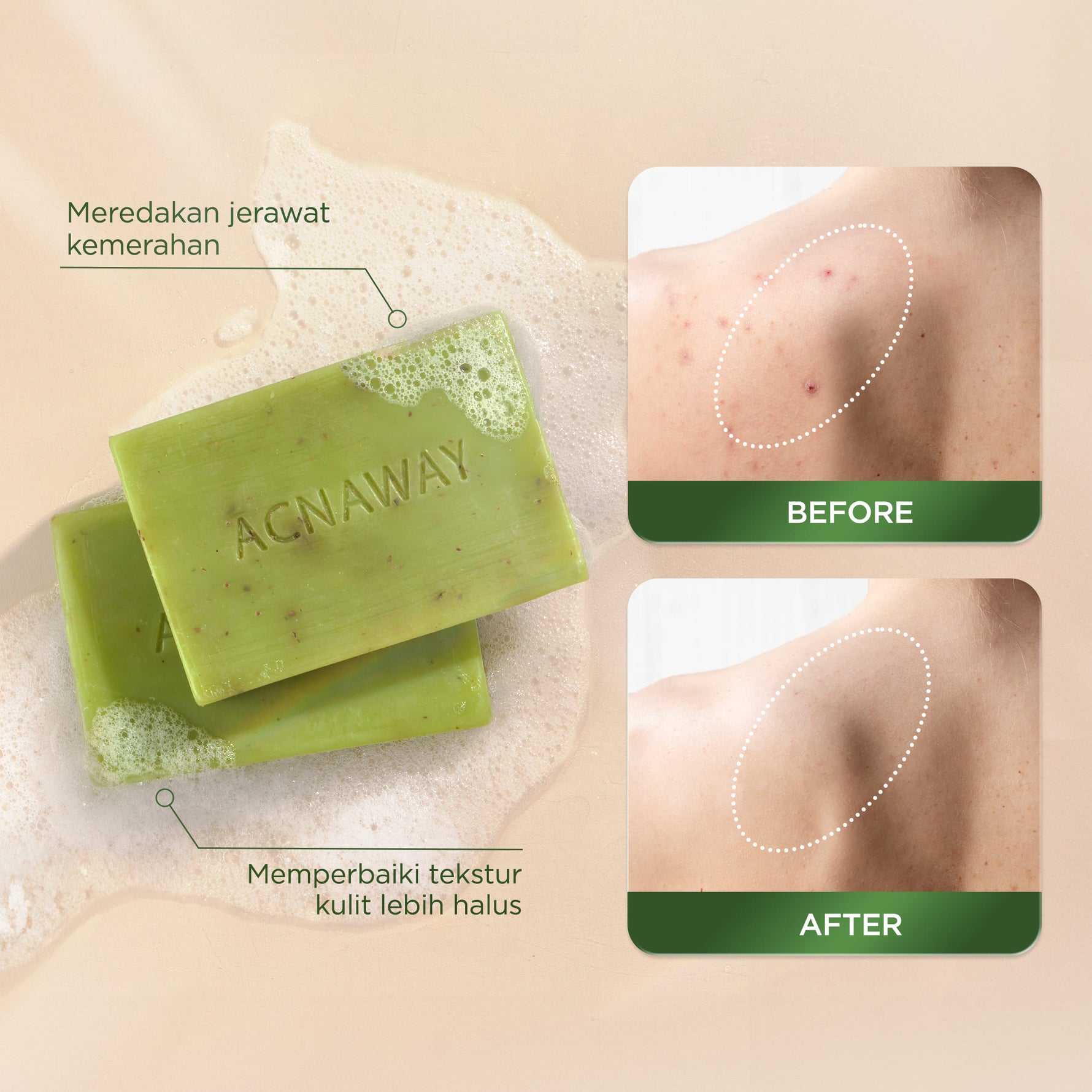 ACNAWAY Mugwort Acne Clear Bar Soap - Sabun Organik Natural Acne Soap untuk Jerawat Badan Tanpa Paraben & Alkohol with Sulfur Calamine Herbal