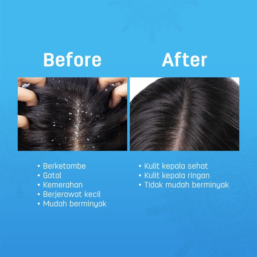 ERHAIR Scalperfect Allantoin & Silk Protein Scalp Soothing Serum 30ml - Perawatan Kulit Kepala Berketombe