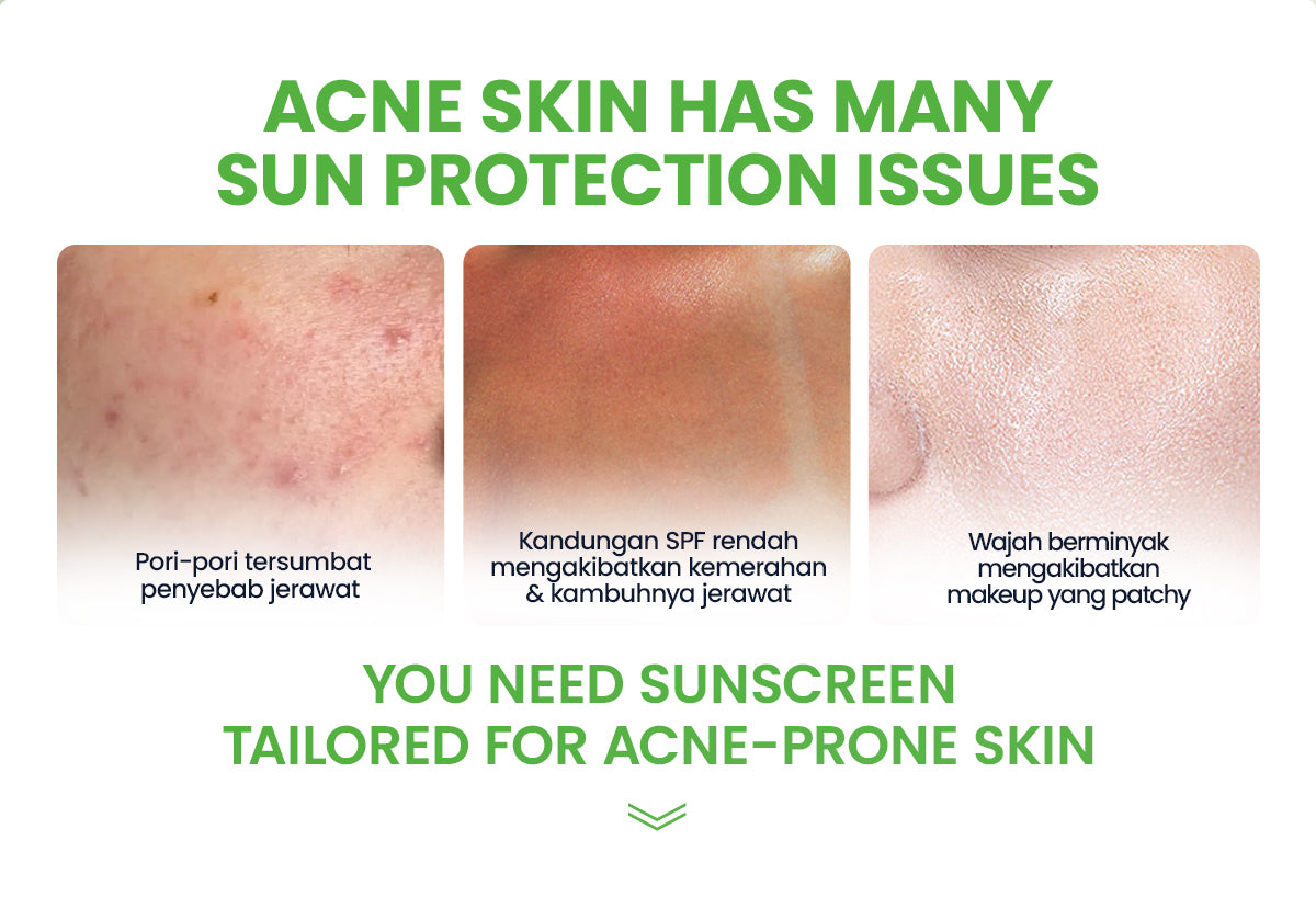 YOU Sunbrella Pro Acnecare Shield Sunscreen SPF 50+ PA++++ Acne Sunscreen Skincare  Collection Sunscreen Acne Prone Skin Melindungi dari Jerawat dan Sinar UV