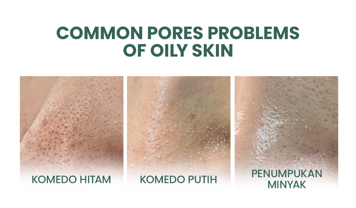 YOU AcnePlus Oil Control Clay Mask Masker Jerawat Masker Komedo Kulit Berminyak Bebas Jerawat