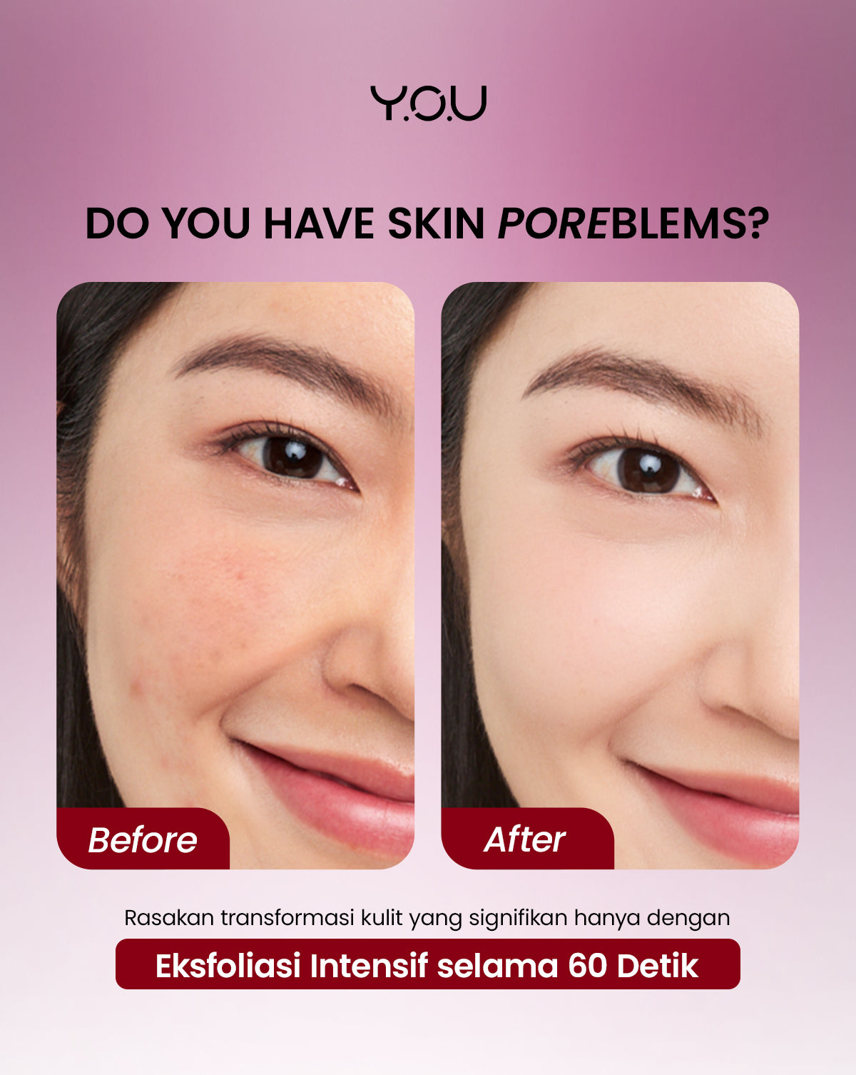 YOU 6% ACID RENEWAL PEELING SERUM AHA BHA PHA Serum Eksfoliasi Untuk Kulit Cerah dan Halus