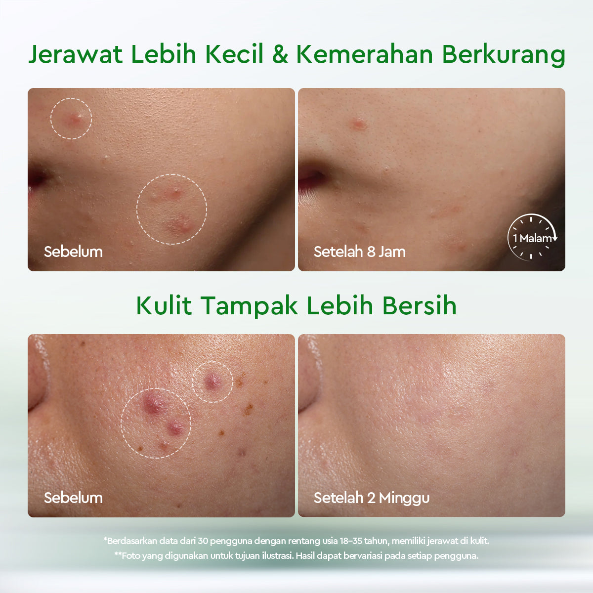 GLAD2GLOW Acne Drying Lotion Mengeringkan Jerawat 8 Jam Dengan Sulfur BHA & Bahan Alami Instant Acne Care Acne Gel Patch Spot Jerawat Serum Moisturizer Acne Skincare Wajah face wash facial Salicylic Acid Niacinamide g2glow official store