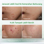 GLAD2GLOW Acne Drying Lotion Mengeringkan Jerawat 8 Jam Dengan Sulfur BHA & Bahan Alami Instant Acne Care Acne Gel Patch Spot Jerawat Serum Moisturizer Acne Skincare Wajah face wash facial Salicylic Acid Niacinamide g2glow official store