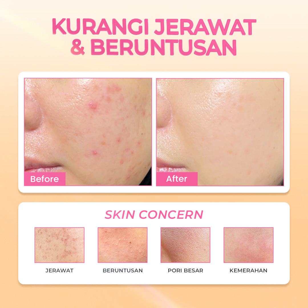 Hanasui Power Acne Serum - Jerawat & Beruntusan Menenangkan & Kurangi Produksi Minyak Salicylic Acid dan Glycolic Acid