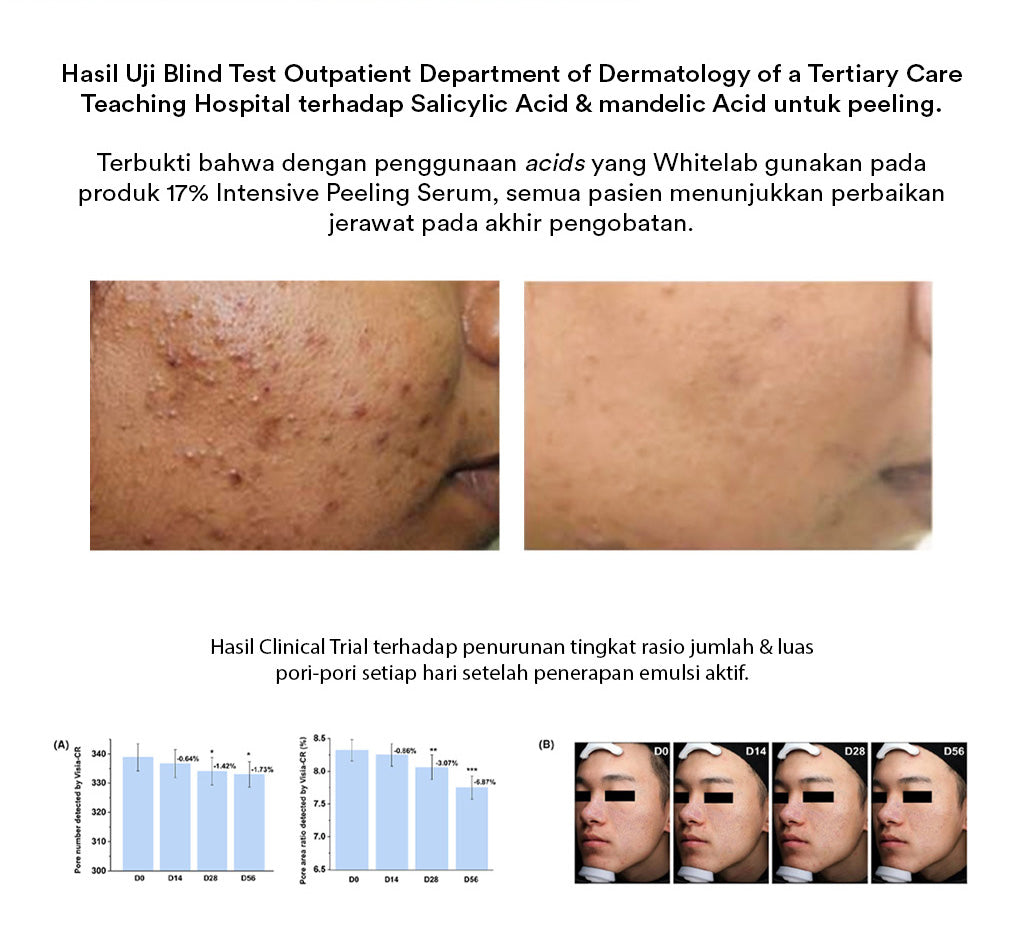Whitelab 17% Intensive Peeling AHA BHA PHA Serum - Serum Eksfoliasi Pengangkat Sel Kulit Mati Memperbaiki Tekstur Kulit Sebum Melting Komedo [BPOM]