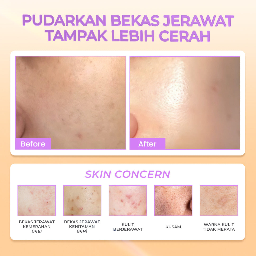 Hanasui Power Post Acne Serum - Pudarkan Bekas Jerawat PIE & PIH Mencerahkan dan Kurangi Kemerahan Cegah Jerawat Kembali