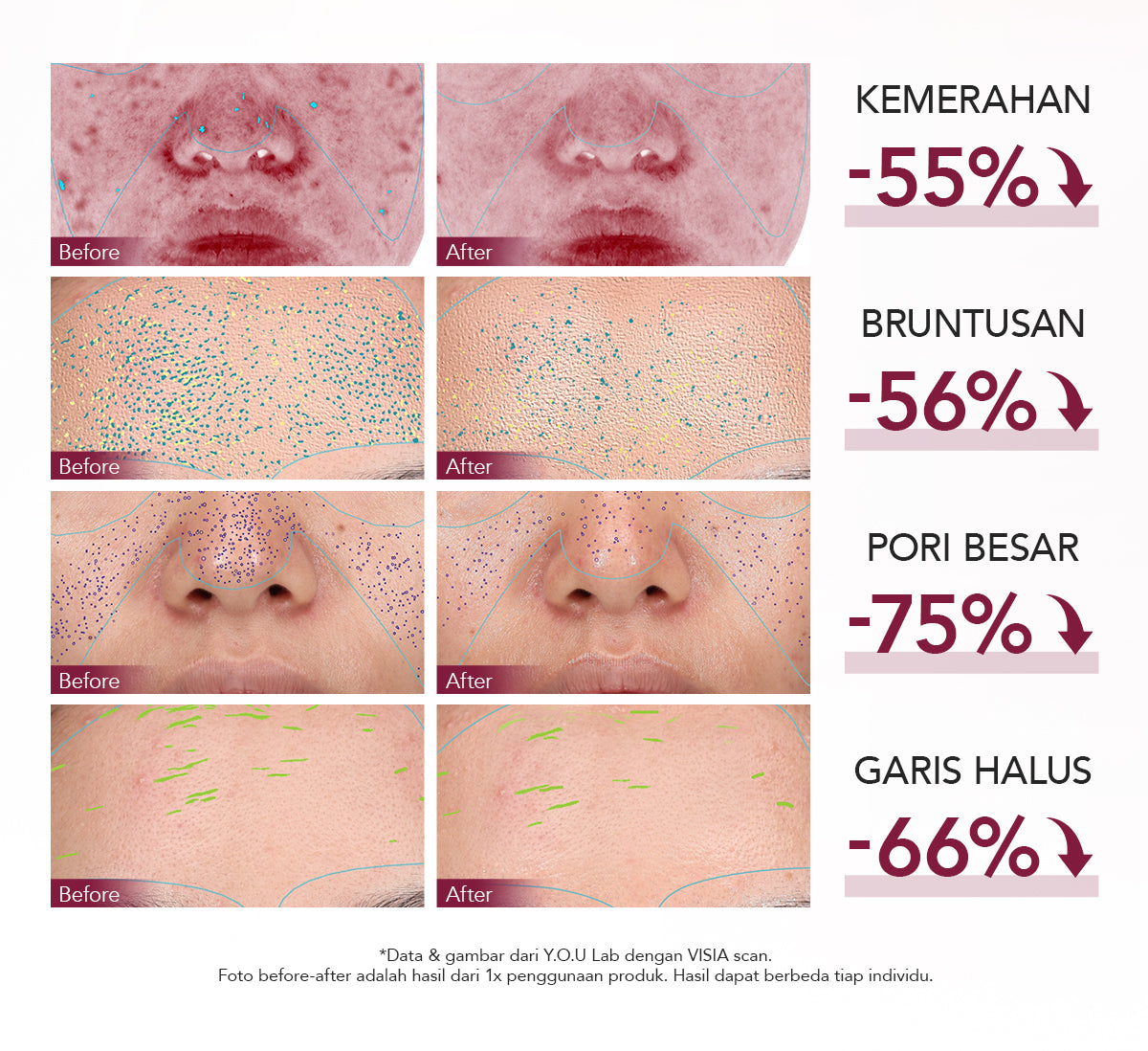 YOU 12% ACID INTENSIVE PEELING SERUM 1.5ML*5 [TRAVEL SIZE] | AHA BHA PHA |Eksfoliasi Kulit Cerah Halus | Pori Besar