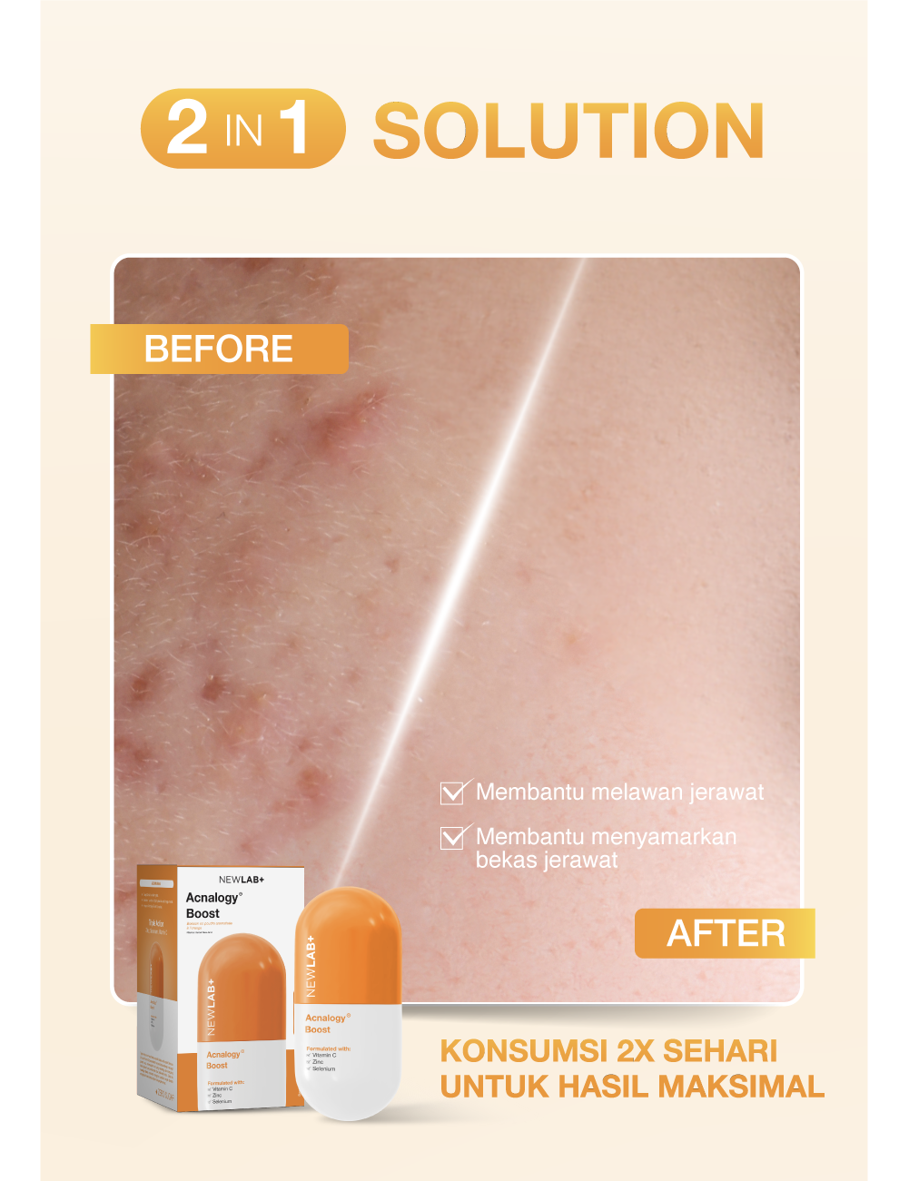 NEWLAB Acnalogy Boost || Acne Supplement || Minuman untuk Pereda Jerawat dan Bekasnya || Obat Jerawat dan Bruntusan 50gr
