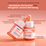 GLOW FX Triple Pack Acne Pure Serum 20ml Serum Jerawat Meradang dan Hempas Jerawat Batu Tanpa Bekas