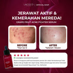 [BEST SELLING] [Abel Cantika's Picks] Lacoco Grape Fruit Acne Fighter Serum Skincare Jerawat Meradang Beruntusan Glow Swiss Glad Skint
